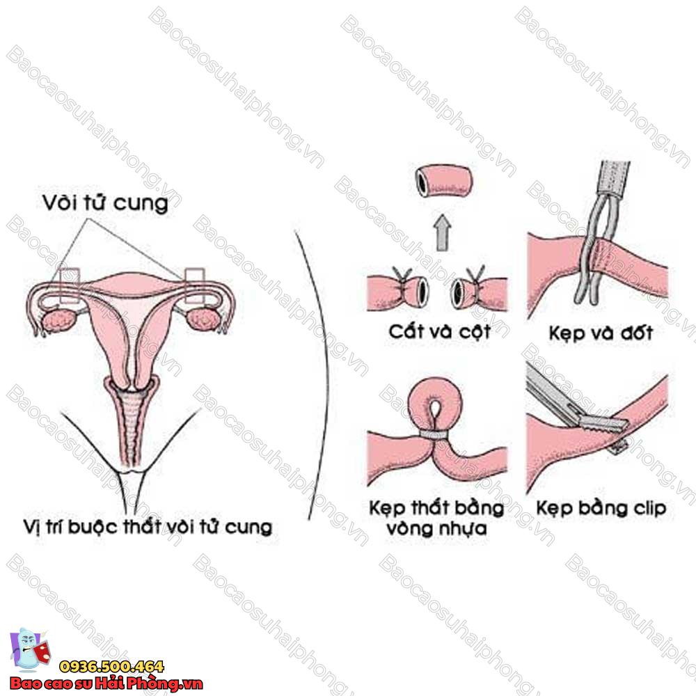 ban-da-biet-gi-ve-quy-trinh-that-ong-dan-trung