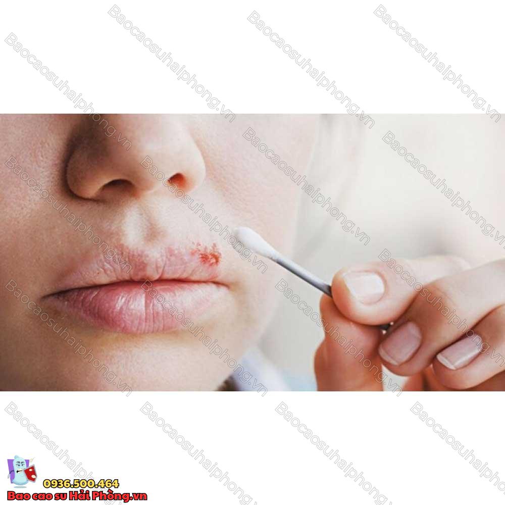 benh-herpes-mieng-3