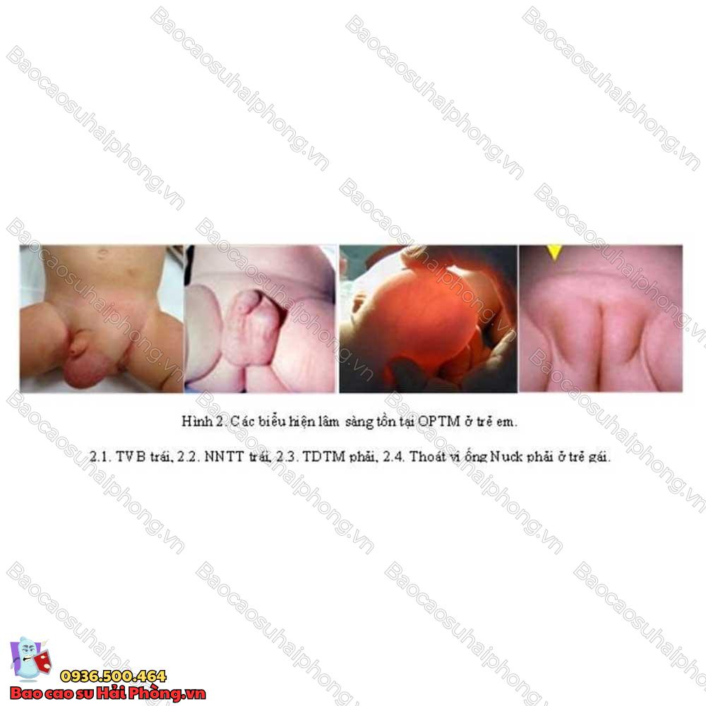 benh-ly-ong-phuc-tinh-mac-2