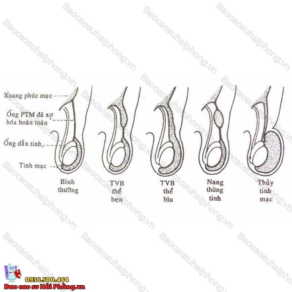 benh-ly-ong-phuc-tinh-mac-3