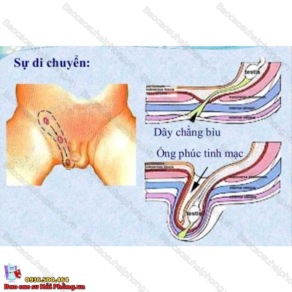 benh-ly-ong-phuc-tinh-mac