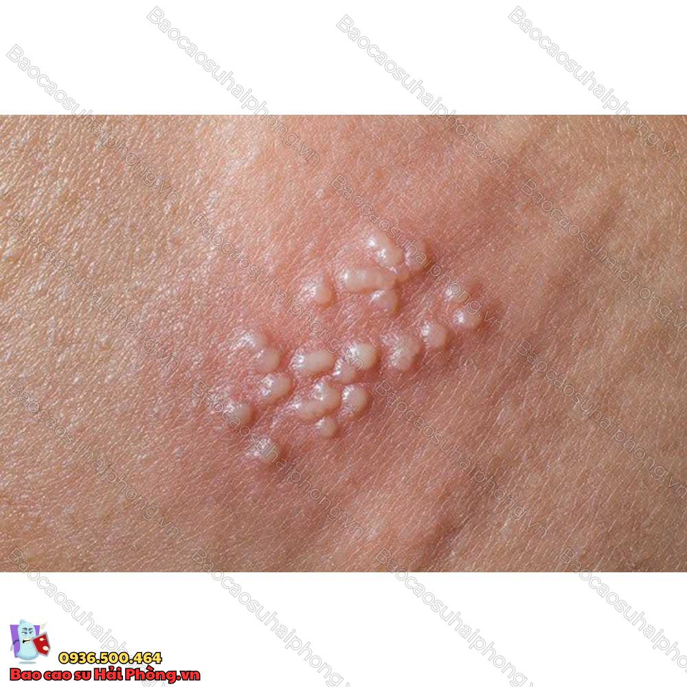 benh-mun-coc-sinh-duc-nam-nguyen-nhan-va-trieu-trung-la-gi-2