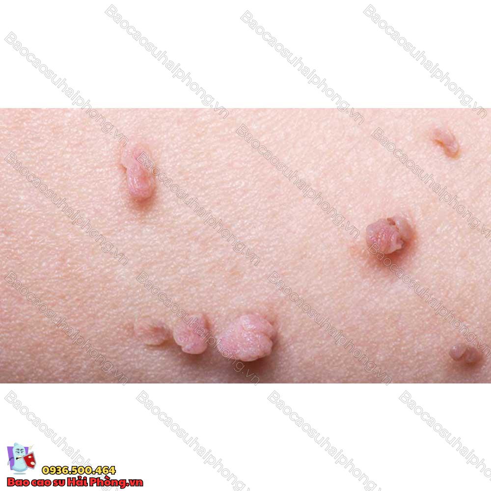 benh-mun-coc-sinh-duc-nam-nguyen-nhan-va-trieu-trung-la-gi-3