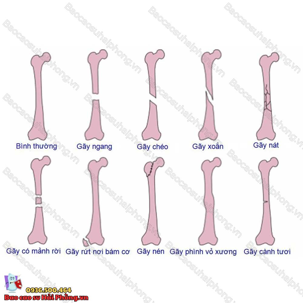 bi-gay-xuong-co-nen-quan-he-khong