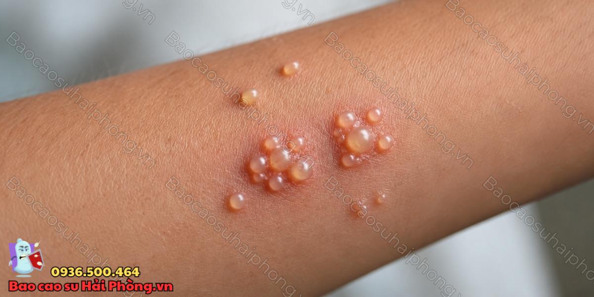 Mụn rộp sinh dục là bệnh gì?
